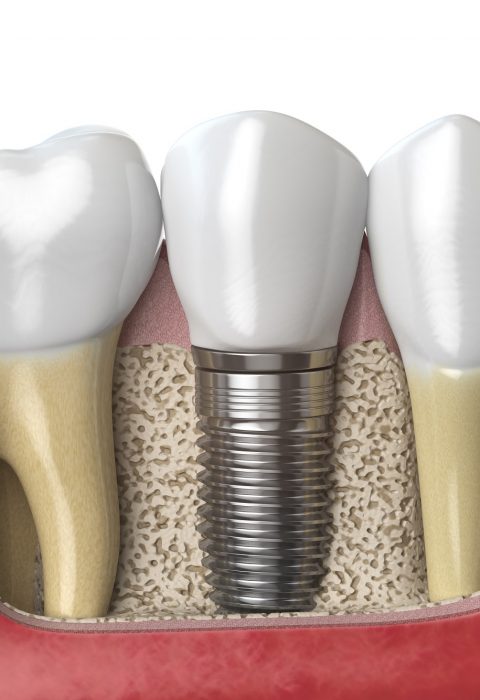 Anatomy of healthy teeth and tooth dental implant in human dentura. 3d illustration