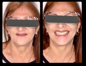 Antes e Depois Implante Feminio